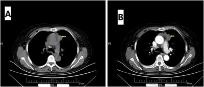 Case report: Multi-antibody–positive myasthenia gravis concomitant myositis associated with thymoma